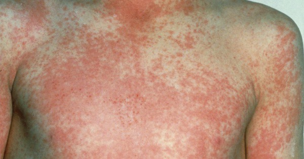 Làm thế nào để ngăn ngừa lây nhiễm sốt tinh hồng nhiệt?
