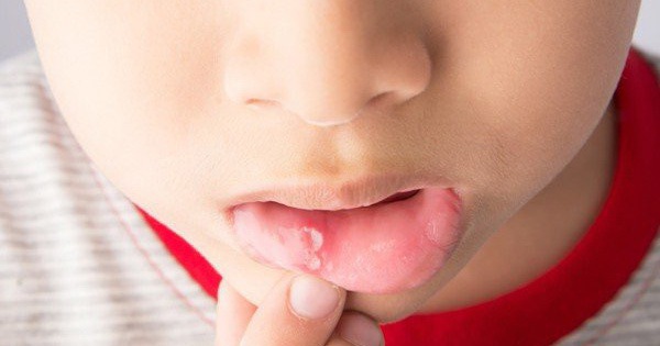 Làm thế nào để chẩn đoán viêm loét niêm mạc miệng ở trẻ em?
