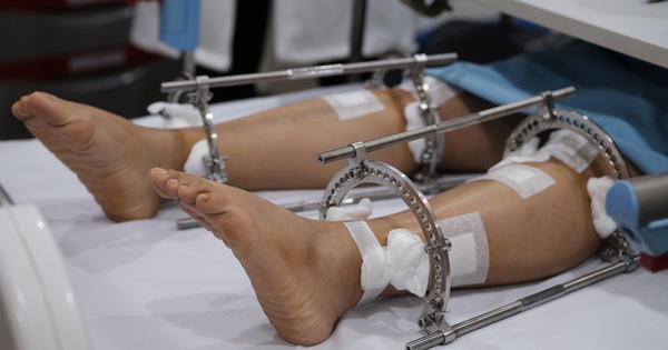  Có bất kỳ rủi ro nào khi thực hiện phẫu thuật kéo dài chân?
