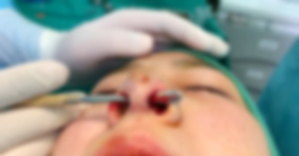 Nâng mũi bị hoại tử: Làm thế nào để phòng ngừa và điều trị hiệu quả?