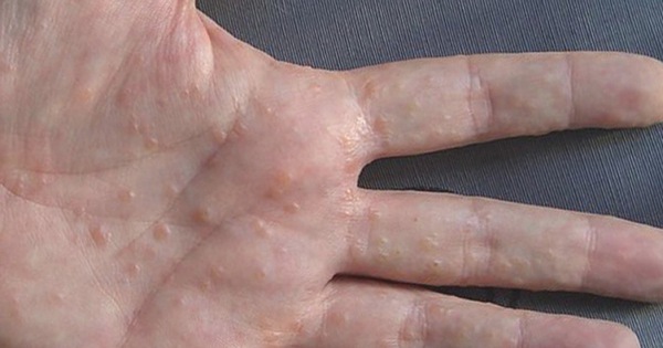 Nước rửa tay gây dị ứng da