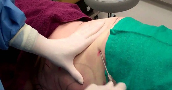 Quy trình thực hiện phẫu thuật hút mỡ bụng như thế nào? 
