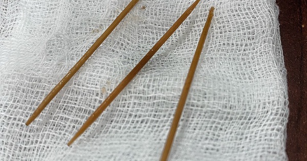 Ngủ quên, nuốt 3 cây tăm xỉa răng phải đi cấp cứu - Tuổi Trẻ Online