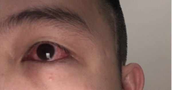  Sốt mắt bị đỏ : Nguyên nhân và cách điều trị hiệu quả