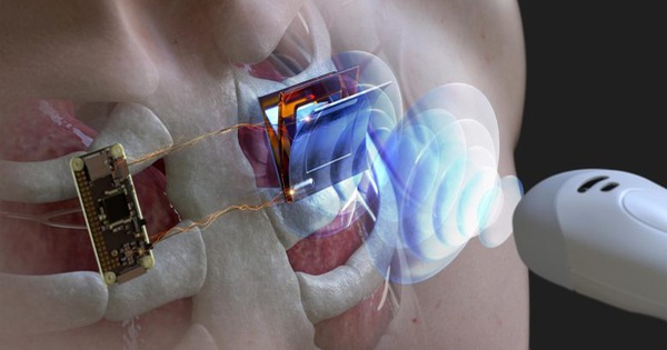 New research helps to charge pacemaker batteries without surgery