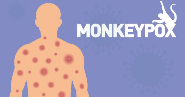 Tại sao các nhà khoa học đòi WHO phải đổi tên virus đậu mùa khỉ?