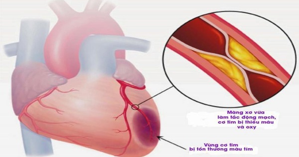 Thông tin cần biết về nhồi máu cơ tim cấp - Tuổi Trẻ Online