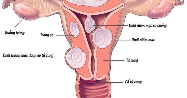 Cách chẩn đoán nhân xơ tử cung?
