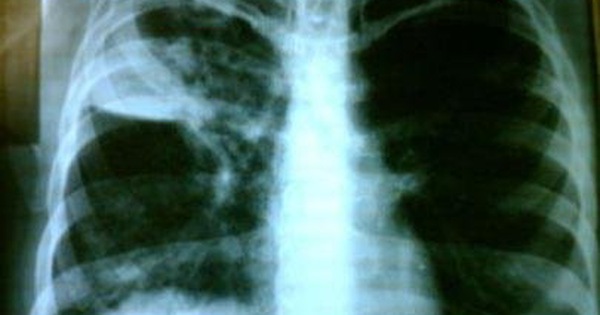 Lao phổi có phải là bệnh di truyền không?
