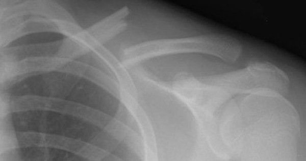 Những biểu hiện và triệu chứng nào xảy ra khi xương quai xanh bị tổn thương hoặc gãy?
