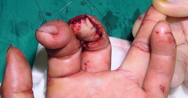 Đầu ngón tay có nhiều máu chảy hơn các vùng khác trên cơ thể?
