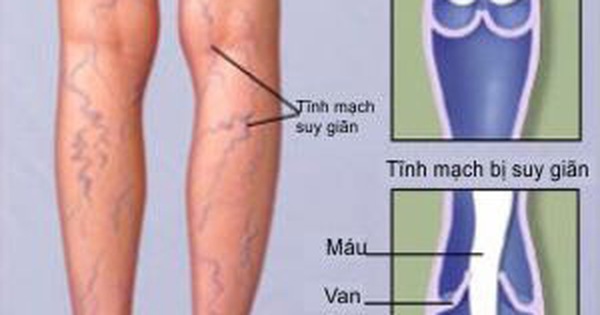 Thuốc giãn tĩnh mạch Venpoten có tác dụng bảo vệ đôi chân khỏi nguy cơ mắc chứng bệnh giãn tĩnh mạch chân không?
