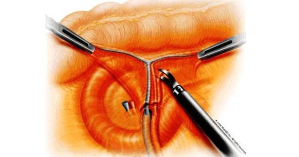 Việc mổ nội soi có tổn thương da và để lại sẹo không?

