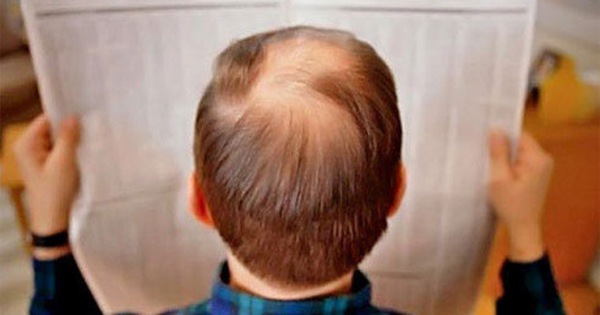 Rụng tóc ở nam giới Nguyên nhân dấu hiệu điều trị và chẩn đoán