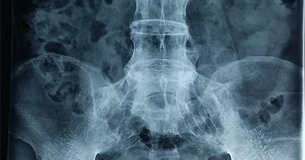 Tìm hiểu cột sống lưng bị lõm trong điều trị viêm amidan