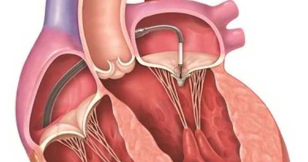 Hở van tim nhẹ có thể gây ra những biến chứng gì?
