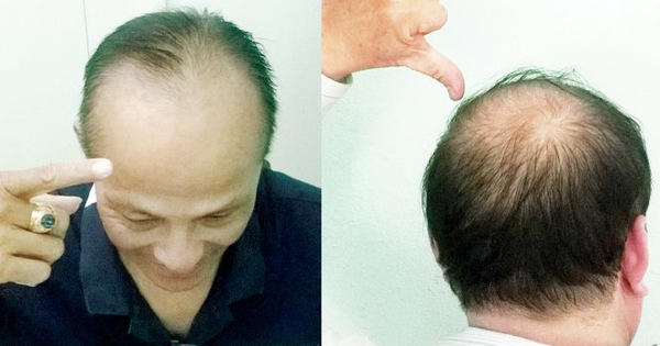 Rụng tóc ở đỉnh đầu nam giới Nguyên nhân  cách cải thiện  Rungtocvn