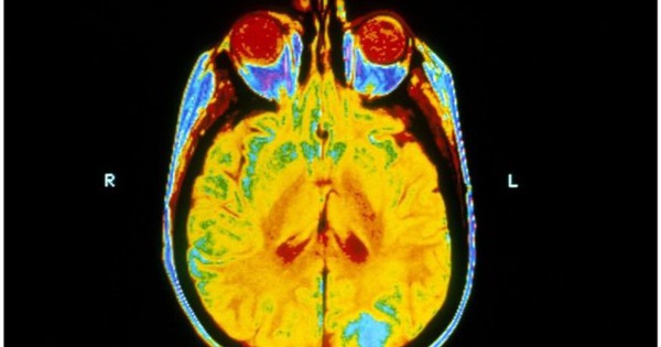Liệu pháp xạ trị não có tác động đến các mô não xung quanh không?

