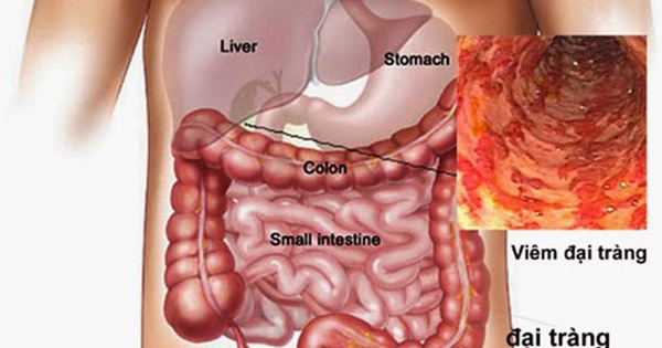 Nếu bị bệnh đại tràng, bạn cần khám và điều trị tại đâu?
