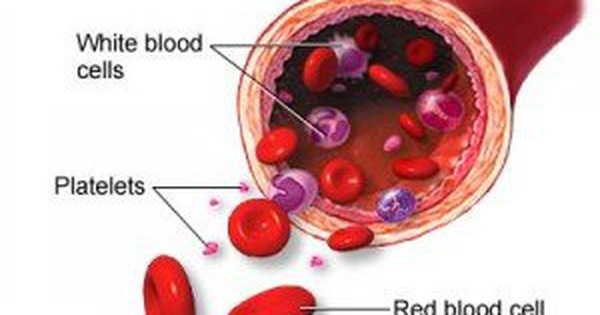 Sốt huyết giảm tiểu cầu có liên quan đến bệnh ITP không? 
