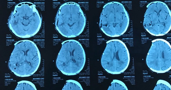 Có những yếu tố nào ảnh hưởng đến dự đoán kết quả sau mổ xuất huyết não và biến chứng sau đó?