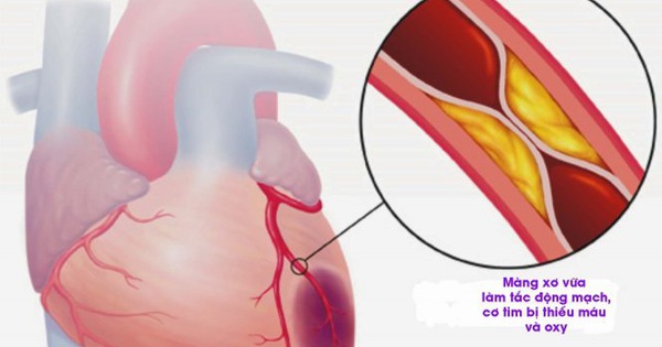 Những yếu tố nguy cơ tăng nguy cơ mắc nhồi máu cơ tim?
