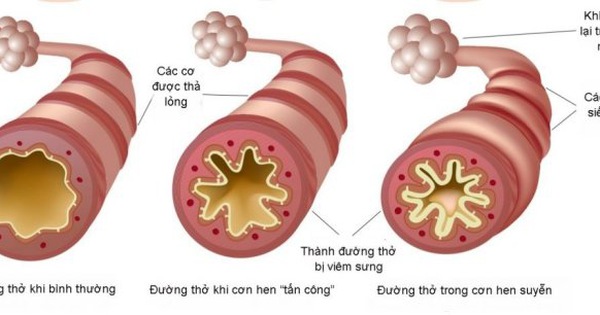 Có những lưu ý nào quan trọng khi sử dụng kháng sinh trong điều trị viêm phế quản?