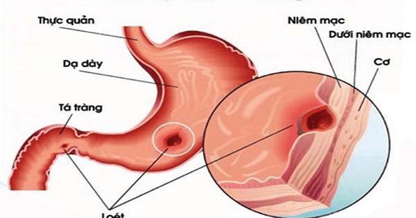 Tìm hiểu về nguyên nhân viêm loét dạ dày tá tràng và cách điều trị hiệu quả